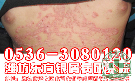 主任分享：银屑病患者日常护理要点