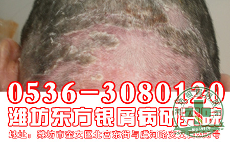 牛皮癣患者的病情怎样进行诊断？【 医院】