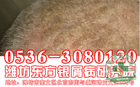 牛皮癣患者生活中可以通过