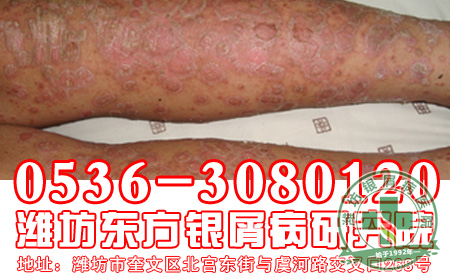 婴儿得银屑病注意事项有哪些？