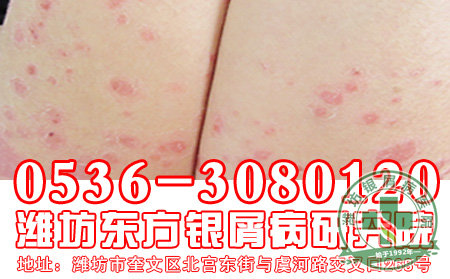 药浴如何治疗银屑病