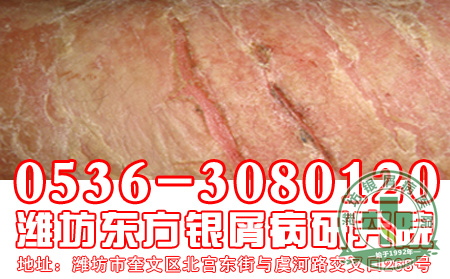 银屑病护理保健，从点滴小事做起