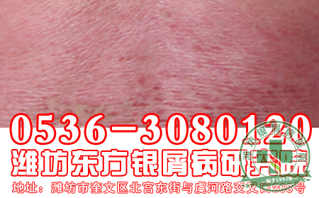 练气功对银屑病有好处