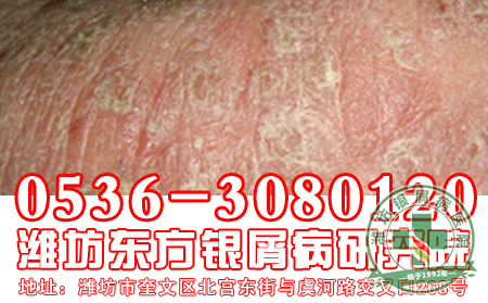 悲伤过度是银屑病常见病因之一吗？【 先进】