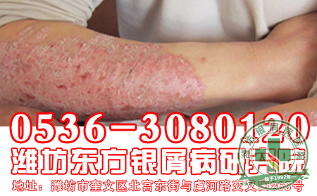 银屑病患者“忌口”有必要吗
