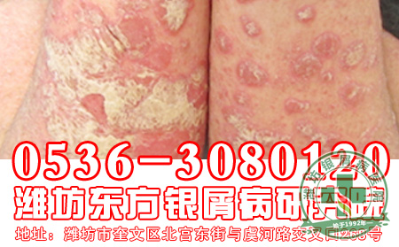 银屑病患者应着重保护身体哪些部位？