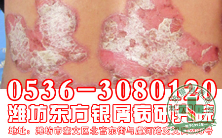冬枣能辅助治疗银屑病不？