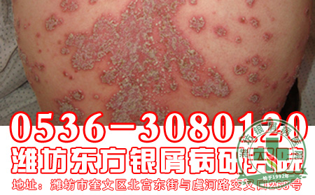 济南银屑病专科医院主任推荐银屑病护理方法