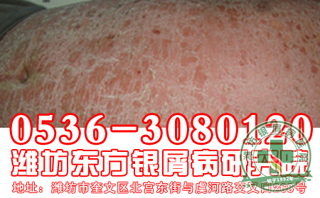 银屑病护理妙方知