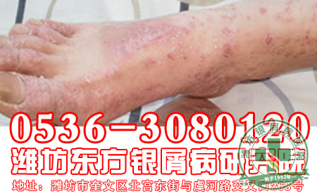  常见的银屑病发病因素你知道吗？【精品】