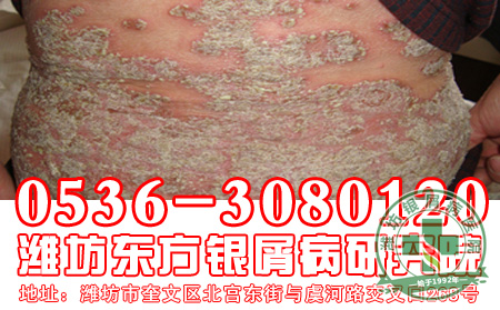 银屑病患者该怎样选择肉食