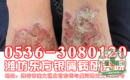 脓疱型银屑病忌讳的饮食