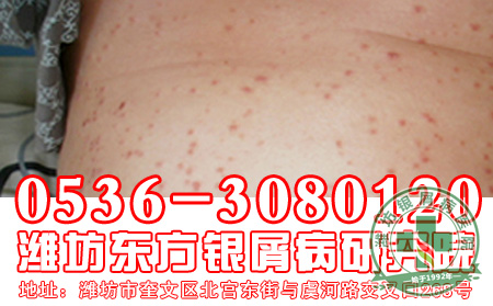 银屑病预防有何良策
