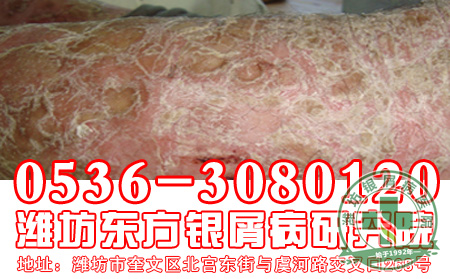 生活中怎样做才能治疗牛