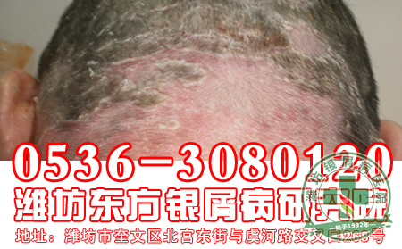 头部银屑病会导致患者秃顶吗