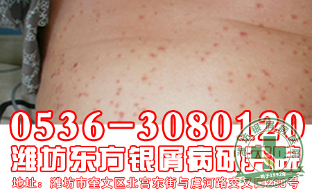 寻常型牛皮