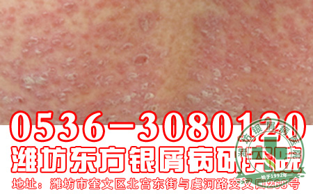 主任简述：儿童银屑病症状表现