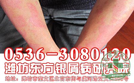 牛皮癣患者佩戴首饰好吗