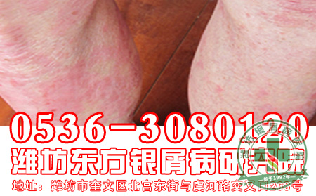 化妆品会引发银屑病