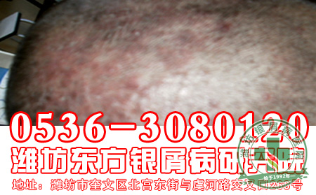 济南牛皮癣医院头部患者前期症状是什么