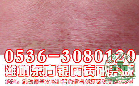 济南牛皮癣医院治疗要分不同时段