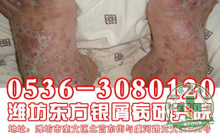 牛皮癣忌口大解密