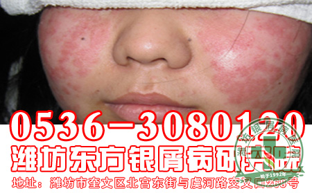 牛皮癣患者如何防辐