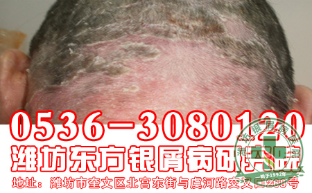 儿童银屑病护理要点大全