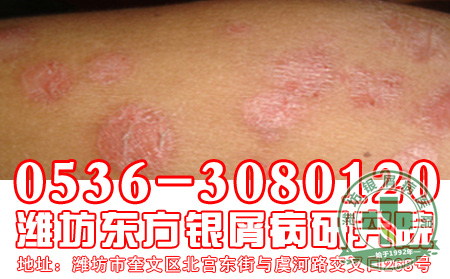 济南银屑病专科医院:银屑病药物选择要遵循的