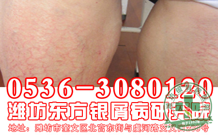 主任答疑：牛皮癣患者能否饮茶