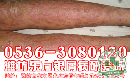 银屑病并不可怕，可怕的是乱求医