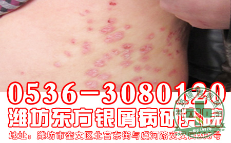 寻常型银屑病饮食注意什么
