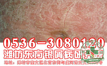 济南牛皮癣医院主任浅谈：牛皮癣与天气的关系