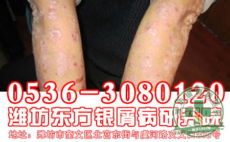 平常型银屑病是防护与治疗