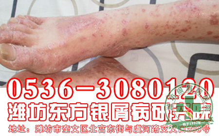 患者对于银屑病的护理工作要知道什么？