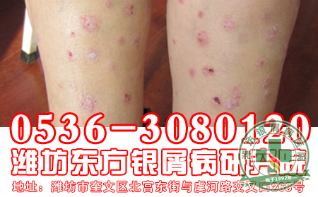 牛皮癣的治疗对于偏方使用要注意什么问题?