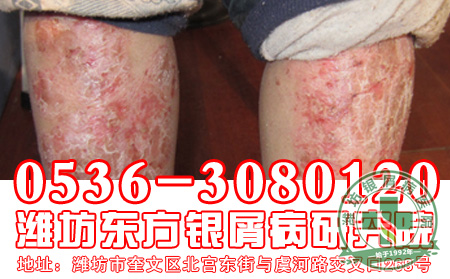什么样的症状预示着银屑病好转？