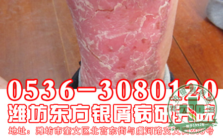 银屑病的偏方要怎样注意使用？