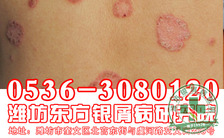 银屑病的发病跟患者的哪些日常因素有关?