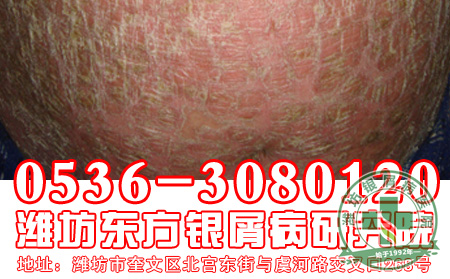 银屑病会给患者造成的身体危害有哪一些？