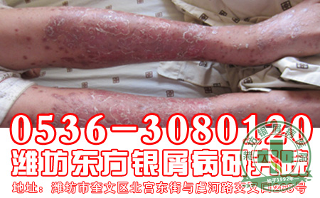 银屑病怎样进行治疗 好？
