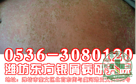 银屑病的发病与患者的什么因素有关系？