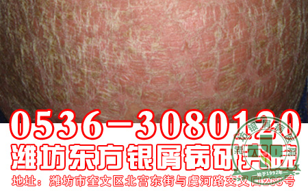 红皮型银屑病发病有什么症状和危害？