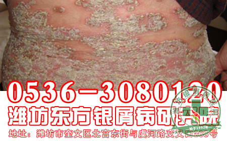 银屑病发病的初期症状是怎么样的？