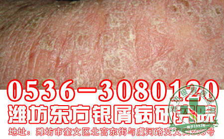银屑病患者的饮食工作要怎样做 好？