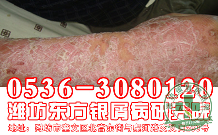 济南专科医院主任说银屑病不会传染,这