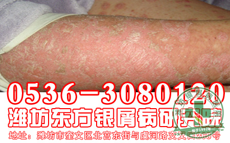 银屑病会给患者造成哪一些危害?