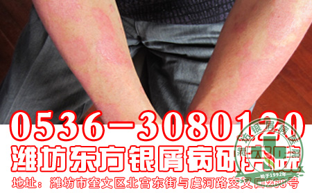 银屑病患者的饮食工作应该怎样做？