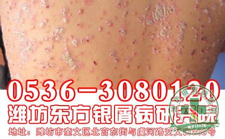 银屑病患者用药要注意什么？