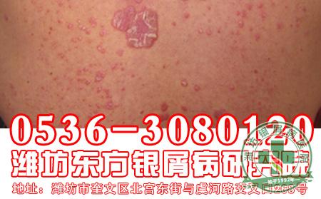 银屑病的治疗工作患者应该做到哪一些？